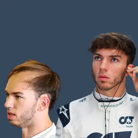 Pierre Gasly Before and After Hair Transplant 