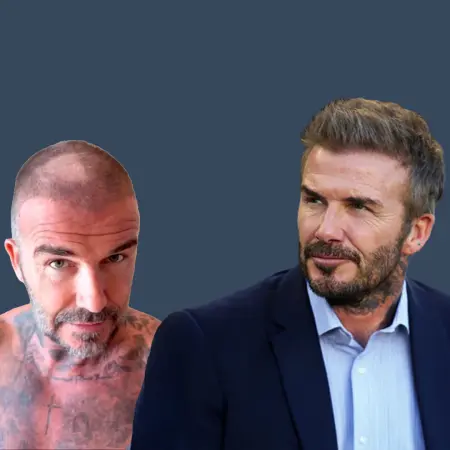 David Beckham Before And After Hair Transplant