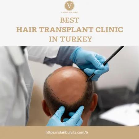 Hair Transplant in Turkey: Cost, Package and Best Clinic