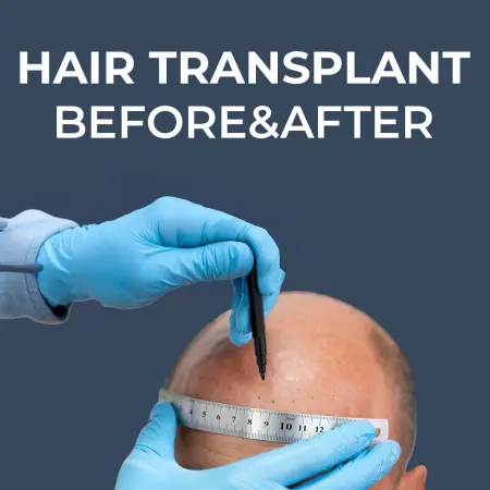 Hair Transplant Before and After Results in Turkey