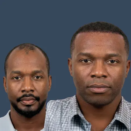 Best Afro Hair Transplant Cost in Istanbul Turkey