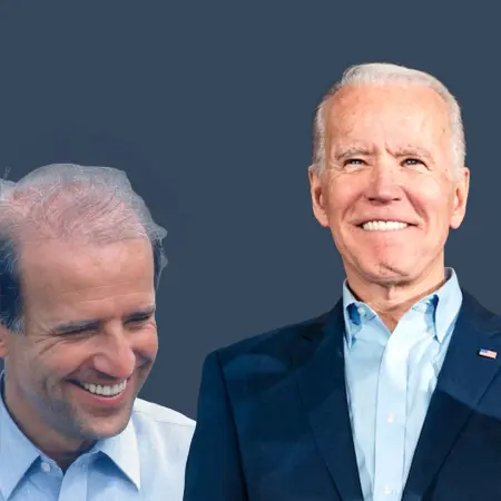 Joe Biden Before and After Hair Transplant 