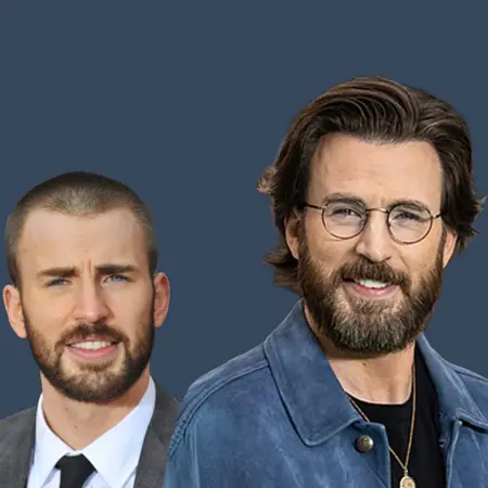 Chris Evans Before and After Hair Transplant