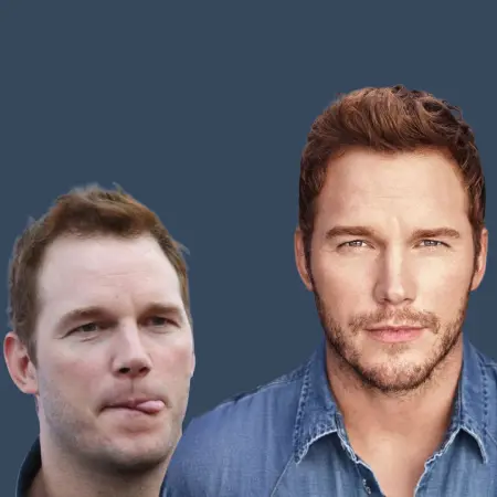 Chris Pratt Before and After Hair Transplant