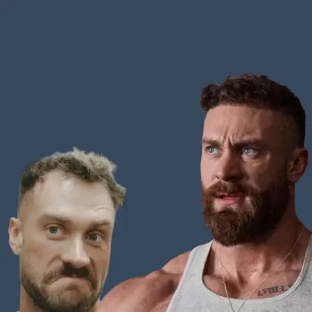 Chris Bumstead Before and After Hair Transplant