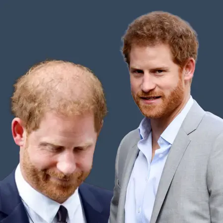 Prince Harry Before and After Hair Transplant