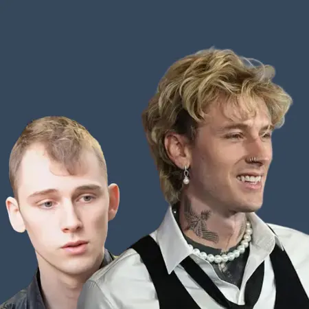 MGK Before and After Hair Transplant Results