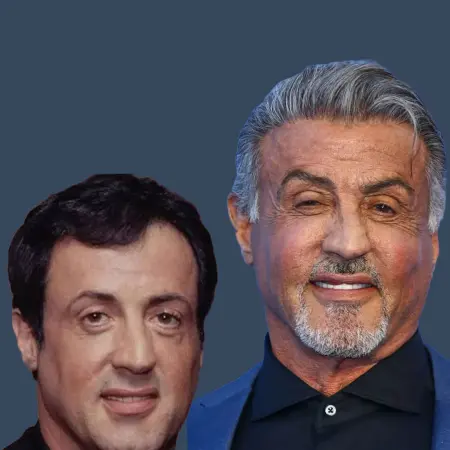 Sylvester Stallone Before and After Hair Transplant