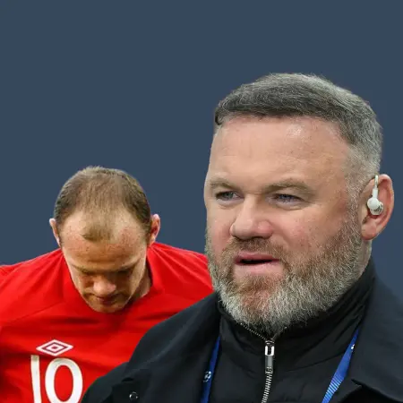 Wayne Rooney Before and After Hair Transplant