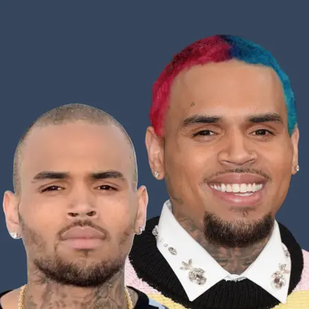 Chris Brown Before and After Hair Transplant