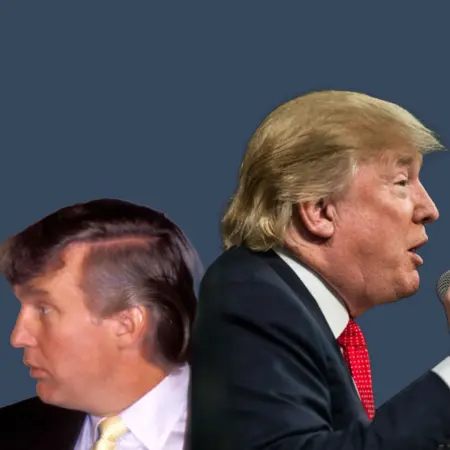 Donald Trump Before and After Hair Transplant 