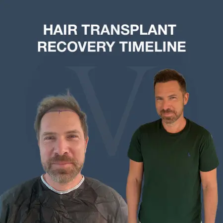 Hair Transplant Recovery Timeline: Healing and Results