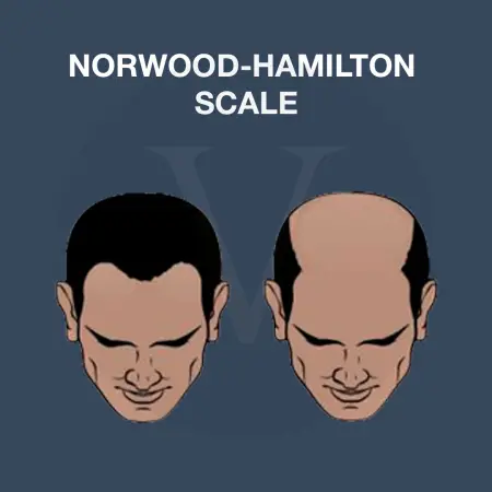 Norwood Hamilton Scale: Hair Loss Stages 1–7 & Hairline