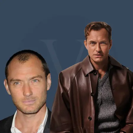 Jude Law Before and After Hair Transplant