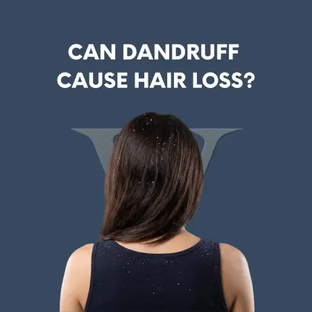 Does Dandruff Cause Hair Loss? Scalp Causes and Solutions
