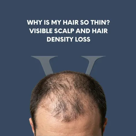 Why Is My Hair So Thin? Visible Scalp and Hair Density Loss