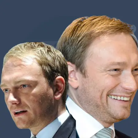 Christian Lindner Haartransplantation: Vorher und Nachher