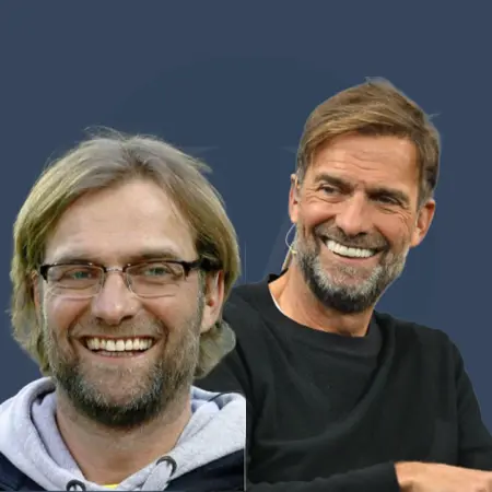 Jürgen Klopp Haare: Vorher und Nachher - Haartransplantation