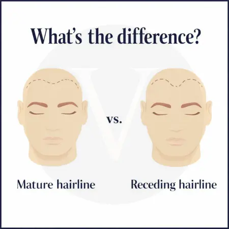 Mature vs Receding Hairline: Early Signs of Hair Loss