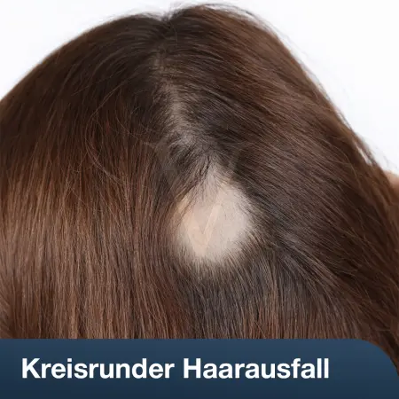 Kreisrunder Haarausfall: Stress, Symptome & Ursachen