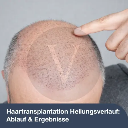 Haartransplantation Heilungsverlauf: Ablauf & Ergebnisse