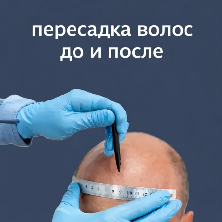 Пересадка волос в Турции: До и После, Реальные Фото