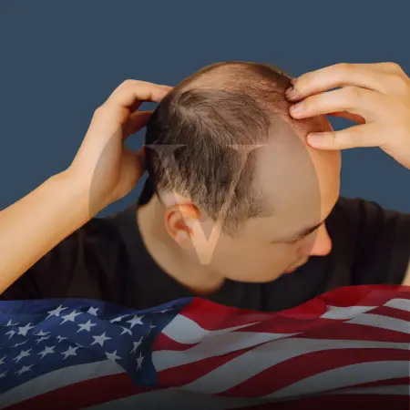 Hair Transplant in USA: Costs, Packages, and Top Cities