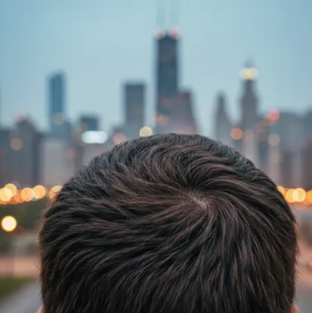 Hair Transplant in Chicago: Procedures, Costs and Clinics