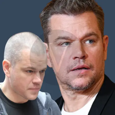 Matt Damon Before and After Hair Transplant 