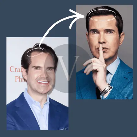Jimmy Carr Before and After Hair Transplant