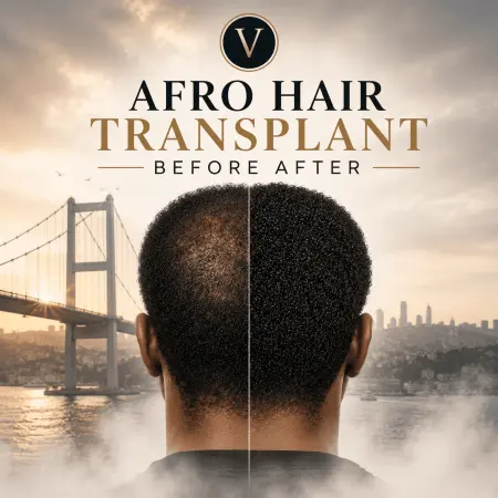 Afro Hair Transplant Before and After Results in Turkey
