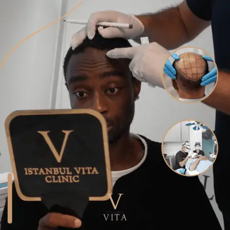 Hair Transplant Turkey for Men: Planning a Natural Result