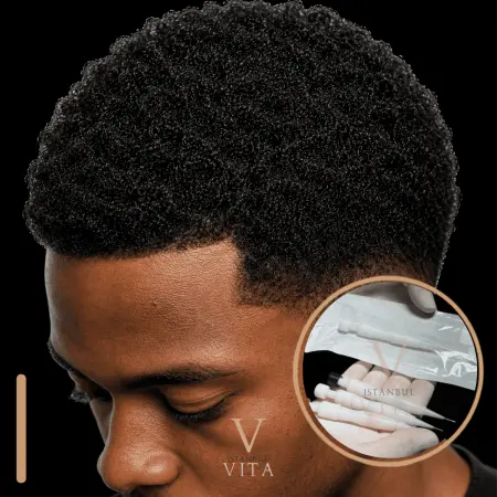 Afro Hair Transplant Punch Size: Which Technique Works Best?