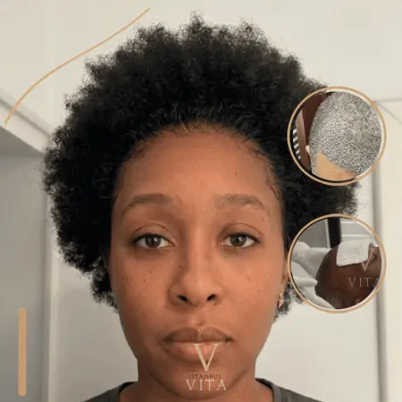 Afro Hair Transplant Aftercare: Scabbing, Wash and Healing