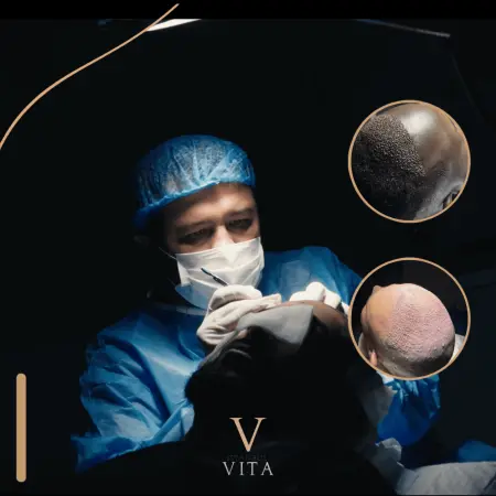 Microscopic Graft Planning in Hair Transplant