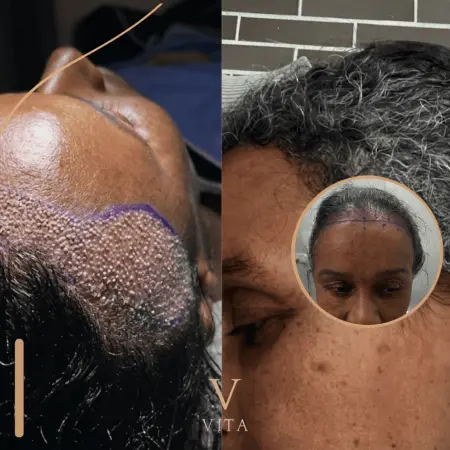 Afro Technique for Curly Hair Transplant | What to Know