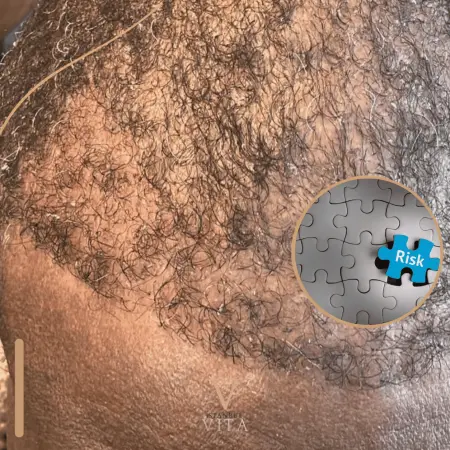 Transection Risk in Afro Hair Transplant | How to Prevent It