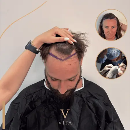 Hairline Design for Different Face Shapes