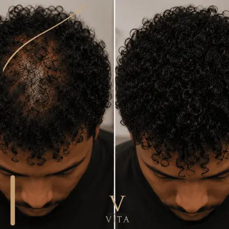 Curl Pattern Preservation After Afro Hair Transplant