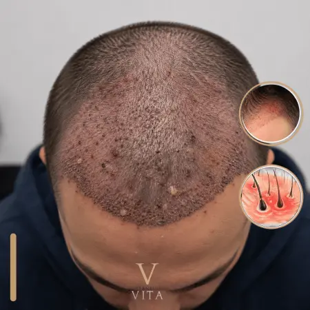 Hair Transplant Infection: 6 Signs You Should Never Ignore