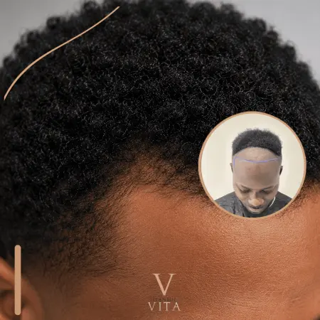 Afro Hair Transplant for Receding Hairline | What to Expect