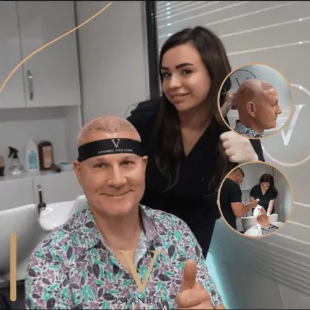 Crown Hair Transplant in Turkey: Planning and Expectations