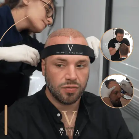Second Hair Transplant in Turkey: When Is It Needed?