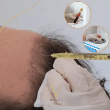 PRP After Hair Transplant: Does It Help Recovery?