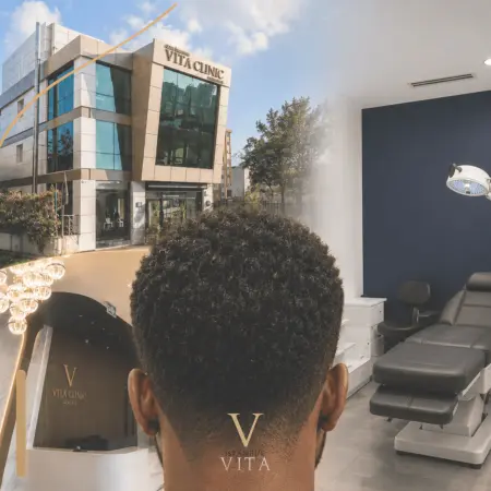 Afro Hair Transplant in Istanbul: Why Experience Matters