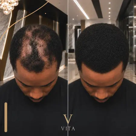 Scarring Alopecia in Afro Hair, Is Hair Transplant Possible?