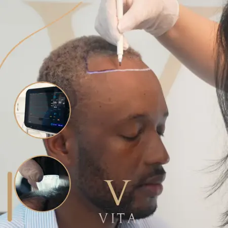 Vorbereitung Haartransplantation: Dos & Don’ts