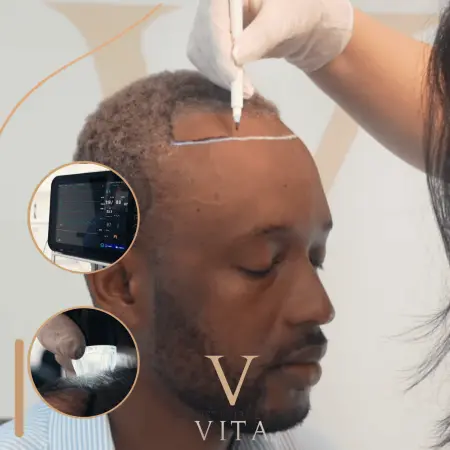 Implant de păr: Ce să faceți și ce să evitați înainte