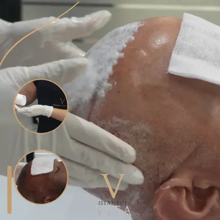 How to Wash Hair After a Hair Transplant | 2026 Guide