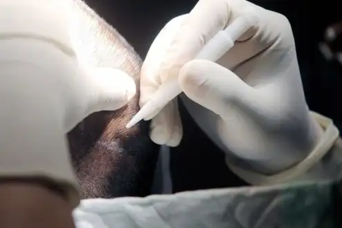 ▷ What is DHI ( No-shave) Hair Transplant? | Istanbul Vita